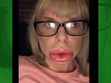 Utiliza un tratamiento para agrandarse los labios y acaba con la boca desfigurada Utiliza un tratamiento para agrandarse los labios y acaba con la boca desfigurada