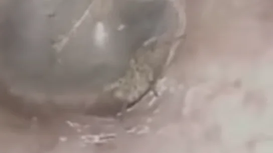 La araña en el conducto auditivo del señor La araña en el conducto auditivo del señor