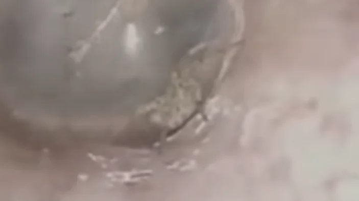 La araña en el conducto auditivo del señor La araña en el conducto auditivo del señor