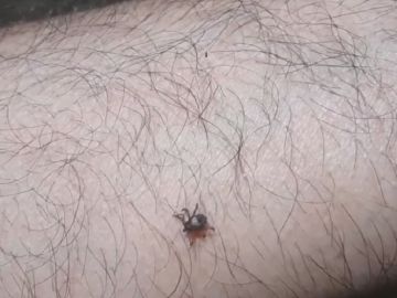 Imagen de una garrapata en un brazo Imagen de una garrapata en un brazo
