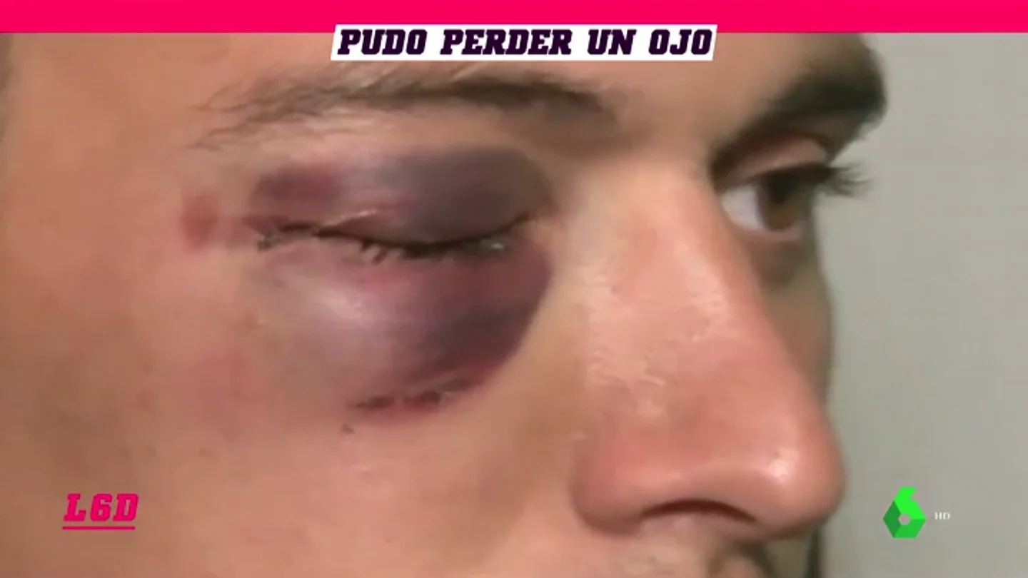 Salvaje agresión a un portero: puñetazo a traición en la cara que casi le hace perder la vista Salvaje agresión a un portero: puñetazo a traición en la cara que casi le hace perder la vista