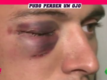 Salvaje agresión a un portero: puñetazo a traición en la cara que casi le hace perder la vista Salvaje agresión a un portero: puñetazo a traición en la cara que casi le hace perder la vista