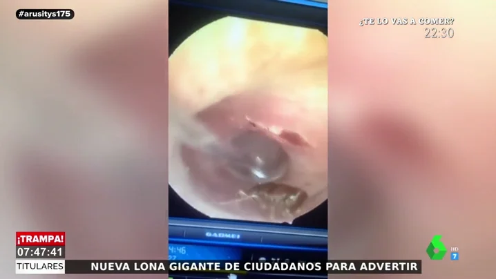 Acude al médico por un dolor de cabeza y descubre que tiene una cucaracha viviendo en el oído