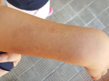 La niña comenzó a autolesionarse como fruto del estrés que vivía en el centro La niña comenzó a autolesionarse como fruto del estrés que vivía en el centro