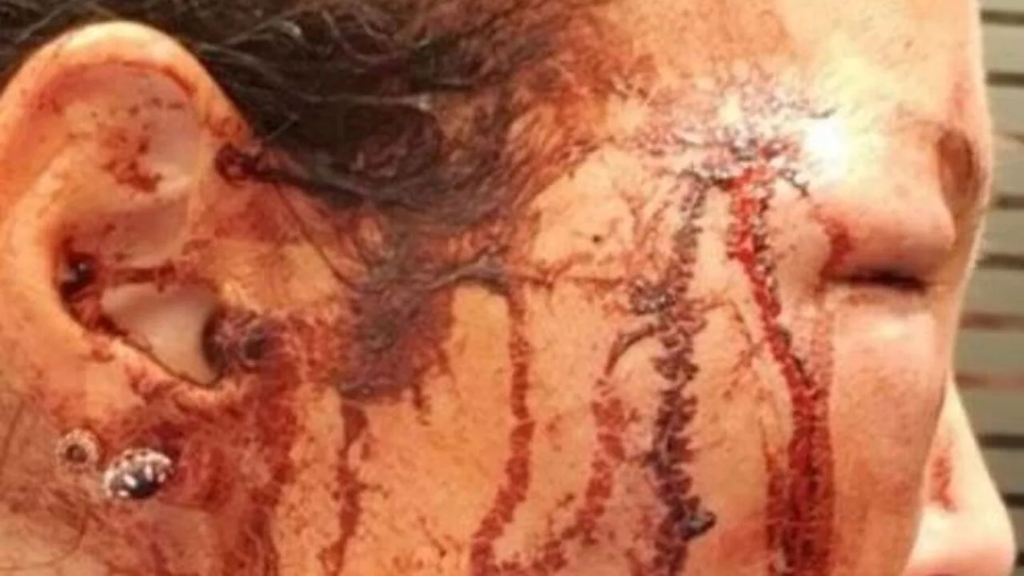Manto Tzavaras enseña la presunta agresión de Papamakarios Manto Tzavaras enseña la presunta agresión de Papamakarios