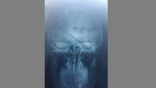 Un bala en la cabeza de un joven en Argentina Un bala en la cabeza de un joven en Argentina