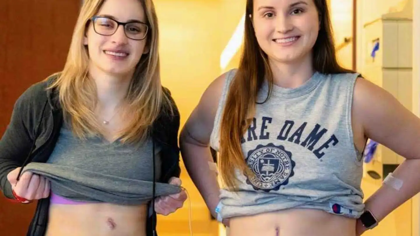Las hermanas Bethany y Hannah Goralski muestras las cicatrices que tienen en su cuerpo tras haber donado sus riñones. Las hermanas Bethany y Hannah Goralski muestras las cicatrices que tienen en su cuerpo tras haber donado sus riñones.