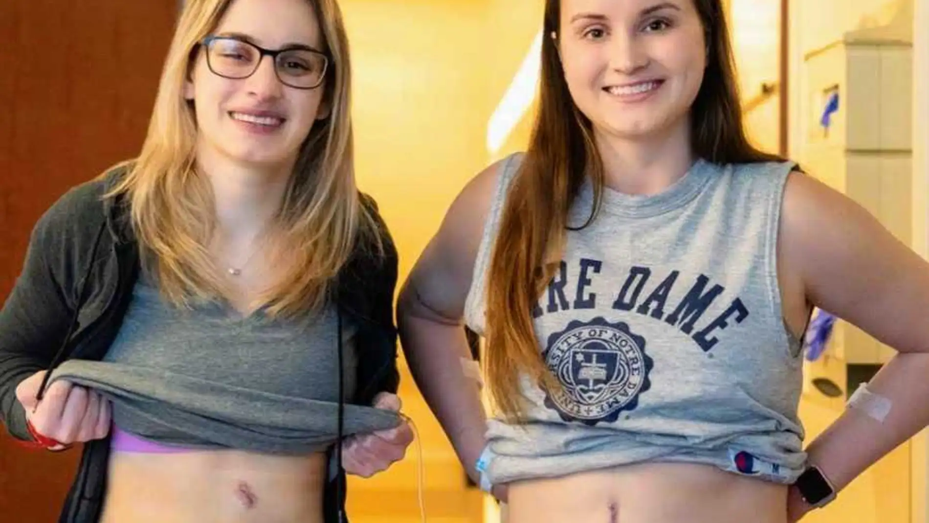 Las hermanas Bethany y Hannah Goralski muestras las cicatrices que tienen en su cuerpo tras haber donado sus riñones.