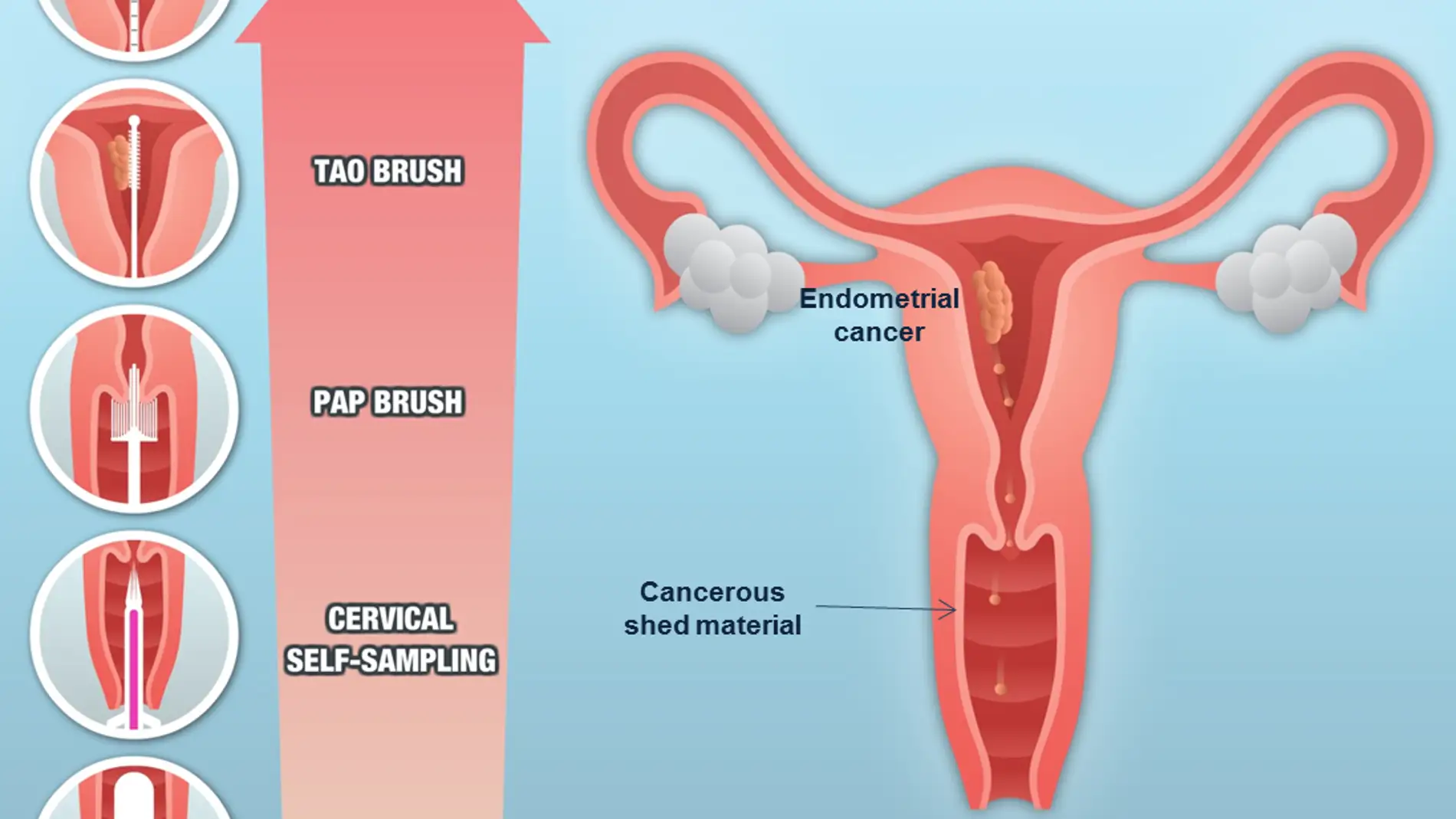 Tipos de muestreos en cáncer de endometrio