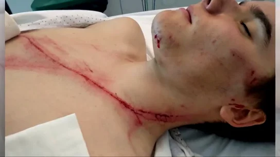 Rajado desde la oreja hasta el pecho: los quitamiedos siguen siendo las cuchillas de la carretera Rajado desde la oreja hasta el pecho: los quitamiedos siguen siendo las cuchillas de la carretera