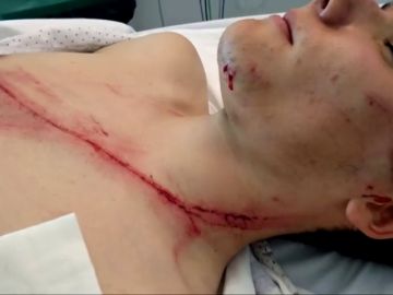 Rajado desde la oreja hasta el pecho: los quitamiedos siguen siendo las cuchillas de la carretera
