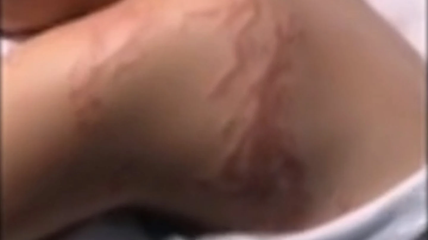 Una joven sufre la brutal picadura de una carabela portuguesa en Murcia Una joven sufre la brutal picadura de una carabela portuguesa en Murcia