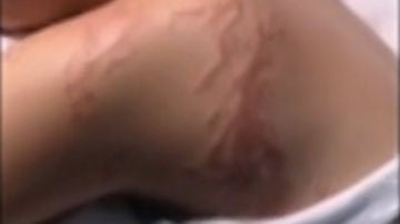 Una joven sufre la brutal picadura de una carabela portuguesa en Murcia