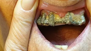 La boca de la mujer después de que le colocaran las prótesis