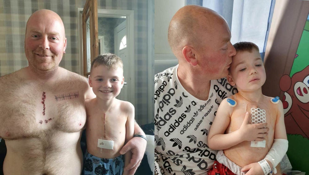 Padre e hijo posan con sus "cicatrices" después de la operación del pequeño.