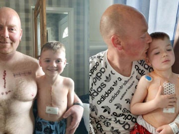 Padre e hijo posan con sus "cicatrices" después de la operación del pequeño. Padre e hijo posan con sus "cicatrices" después de la operación del pequeño.