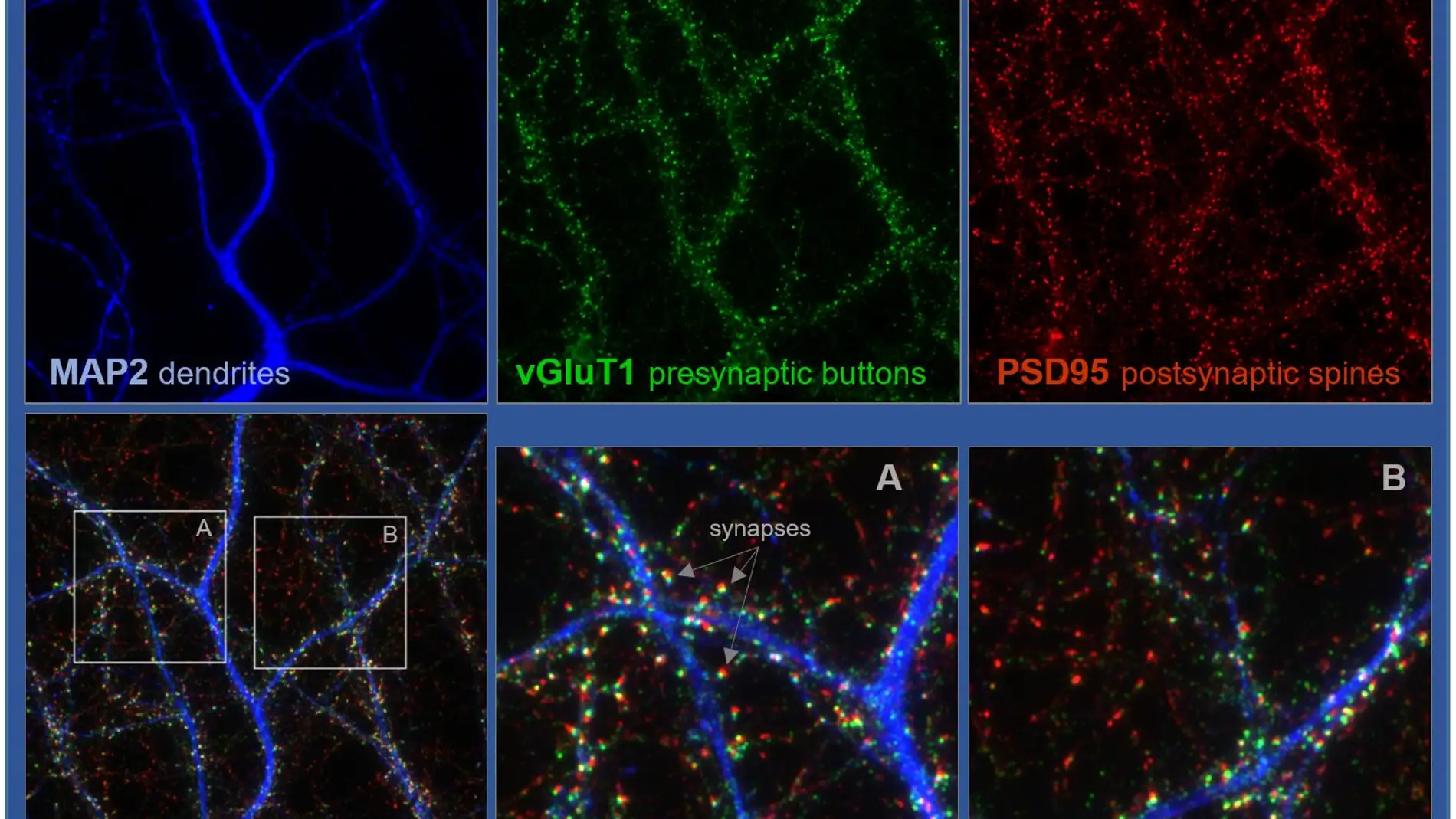 Detalle de neuronas de hipocampo crecidas durante 18 días, fijadas y procesadas para analizar sinapsis excitadoras.