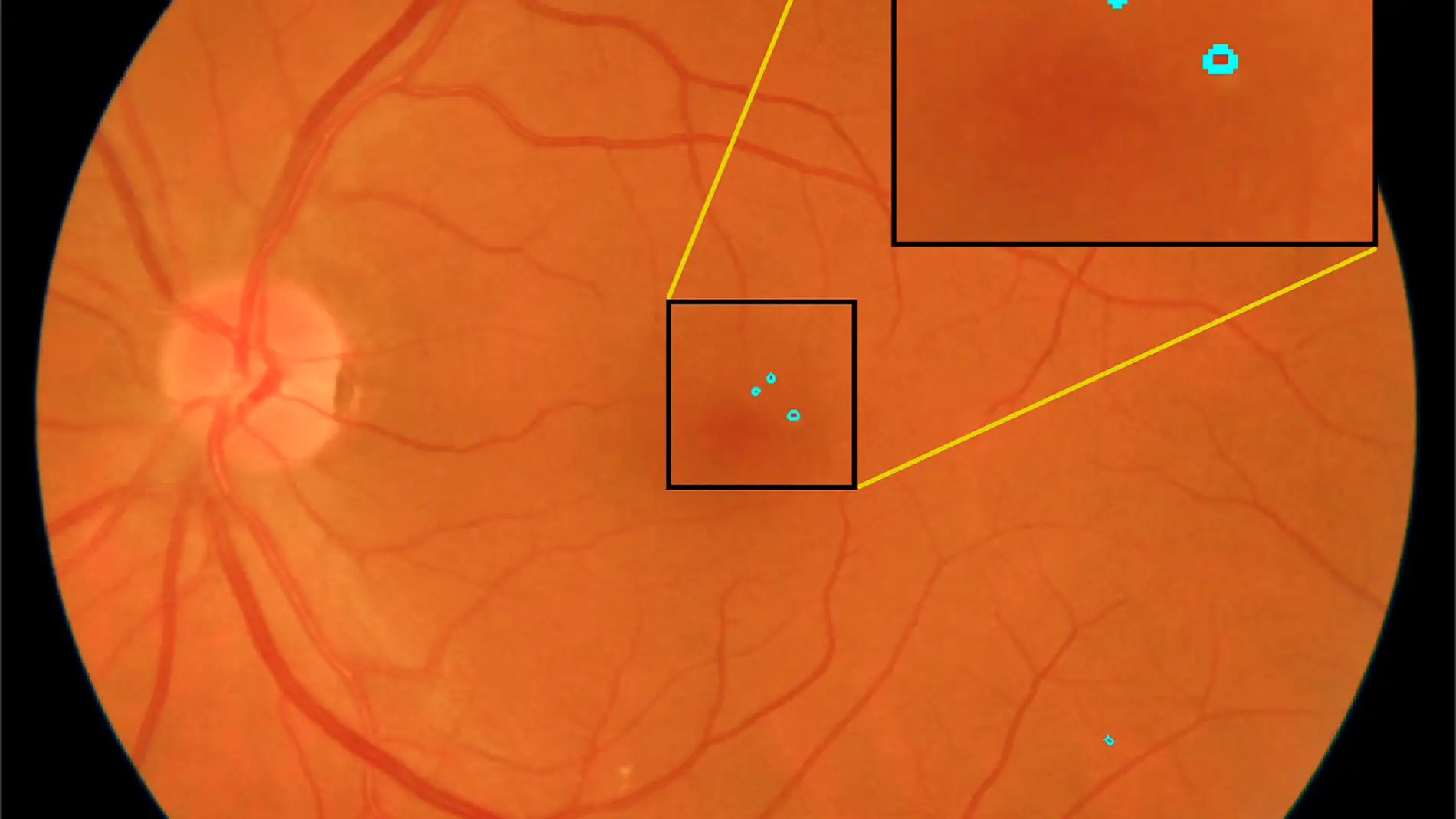 Un sistema automatico para detectar lesiones rojas en la retina