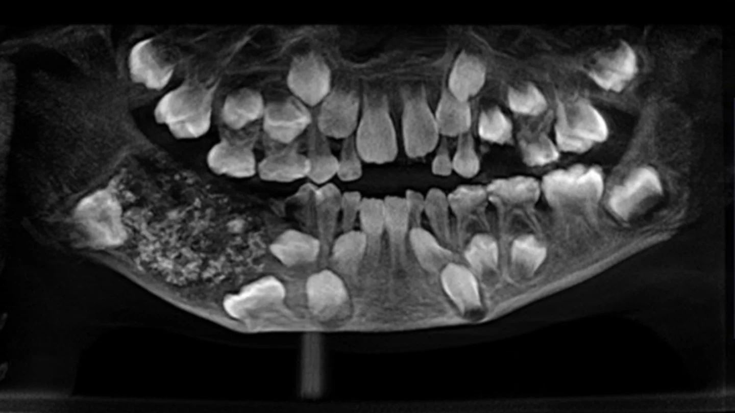 La radiografía del niño de 7 años con 526 dientes en su mandíbula La radiografía del niño de 7 años con 526 dientes en su mandíbula