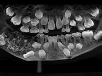 La radiografía del niño de 7 años con 526 dientes en su mandíbula La radiografía del niño de 7 años con 526 dientes en su mandíbula