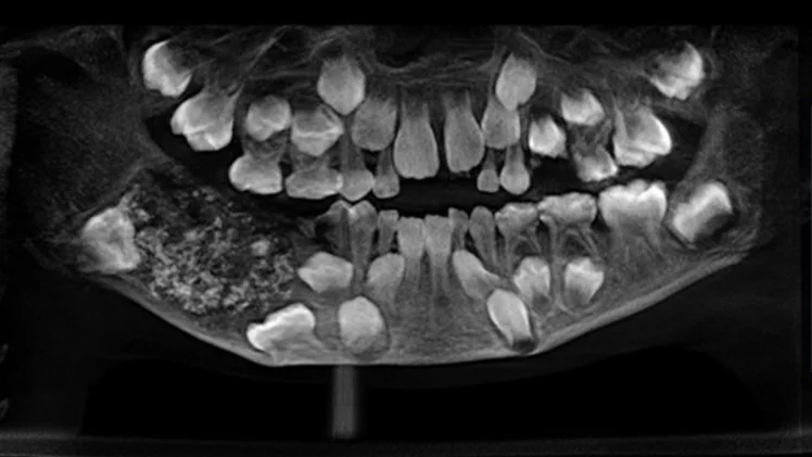 La radiografía del niño de 7 años con 526 dientes en su mandíbula