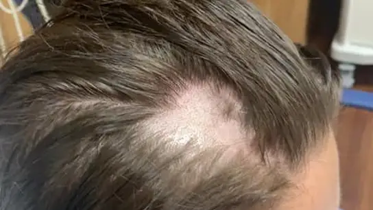 Una joven se queda calva tras usar un acondicionador común Una joven se queda calva tras usar un acondicionador común