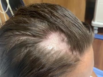 Una joven se queda calva tras usar un acondicionador común Una joven se queda calva tras usar un acondicionador común
