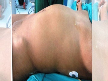 El bulto en el abdomen de la paciente con 'fetus in fetu' El bulto en el abdomen de la paciente con 'fetus in fetu'