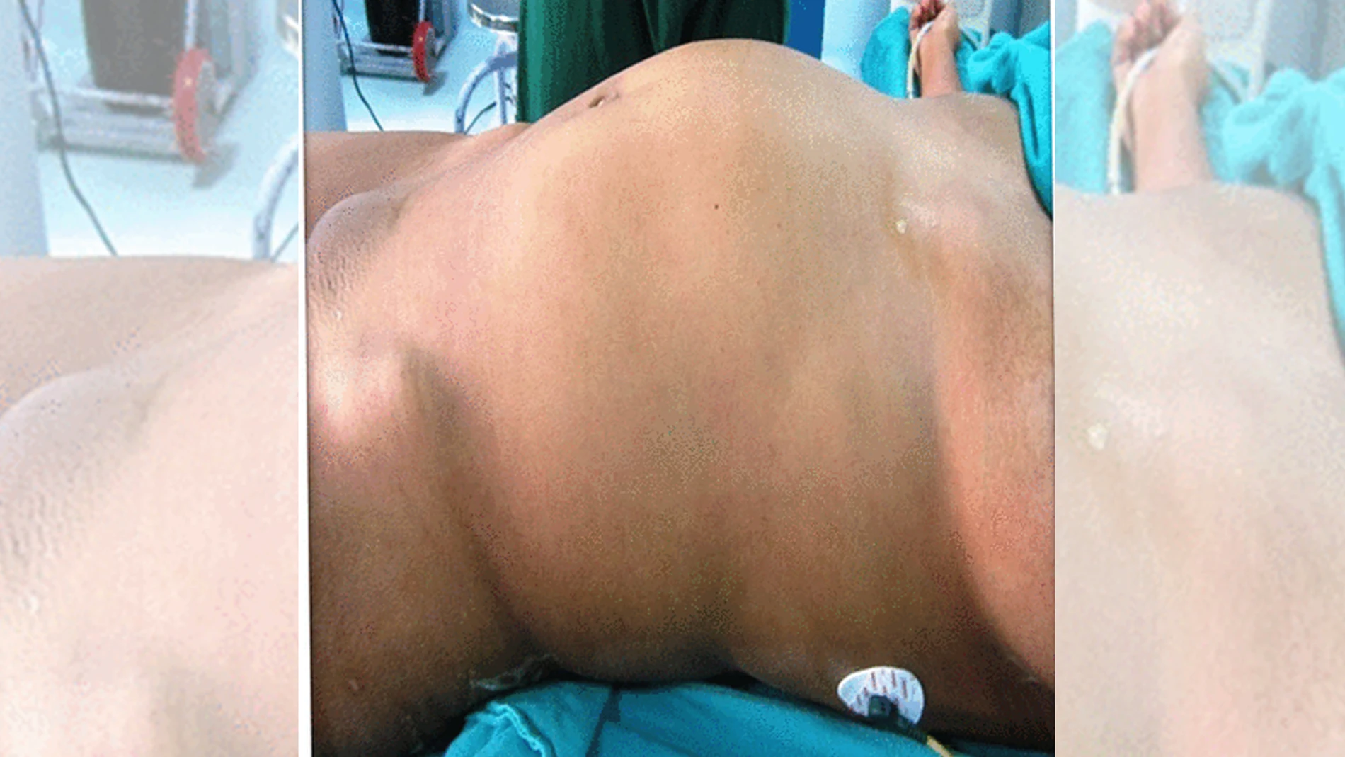 El bulto en el abdomen de la paciente con 'fetus in fetu'