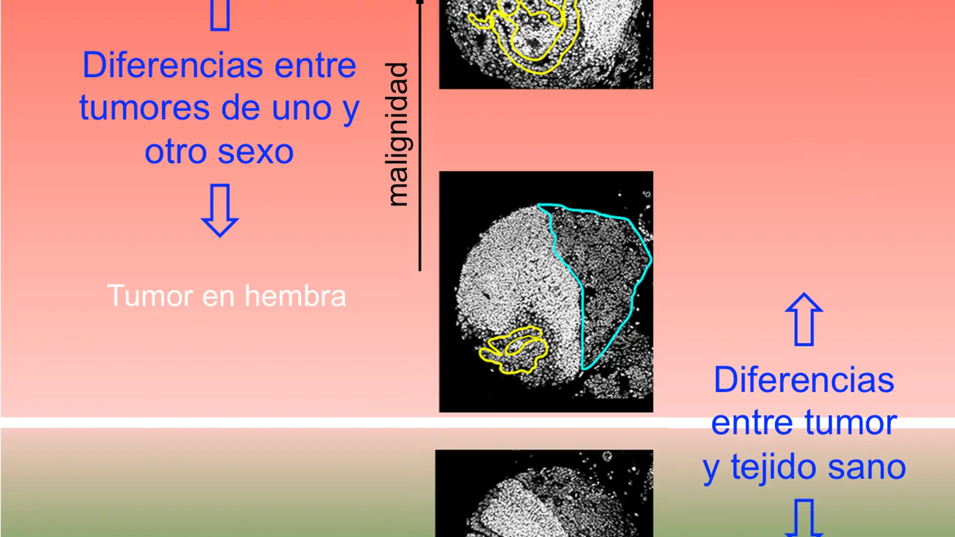 Identifican genes relacionados con la agresividad del cancer segun el sexo