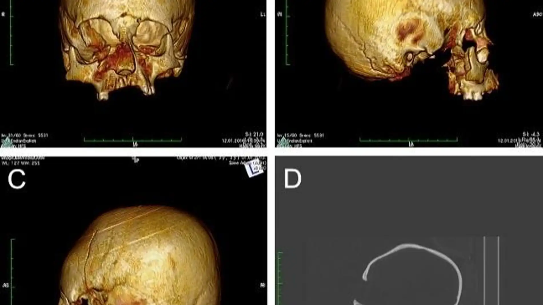 Hallan craneos con deformacion artificial de hace 1.500 anos en Europa