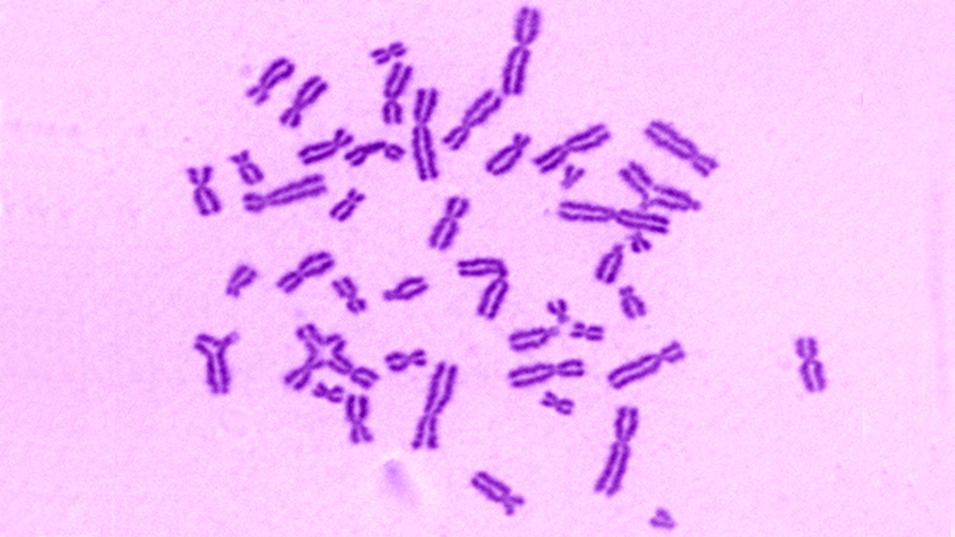 deficiente producción de células sanguíneas en anemia de Fanconi
