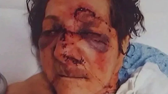 La mujer tiene varias fracturas y ha necesitado múltiples puntos de sutura La mujer tiene varias fracturas y ha necesitado múltiples puntos de sutura