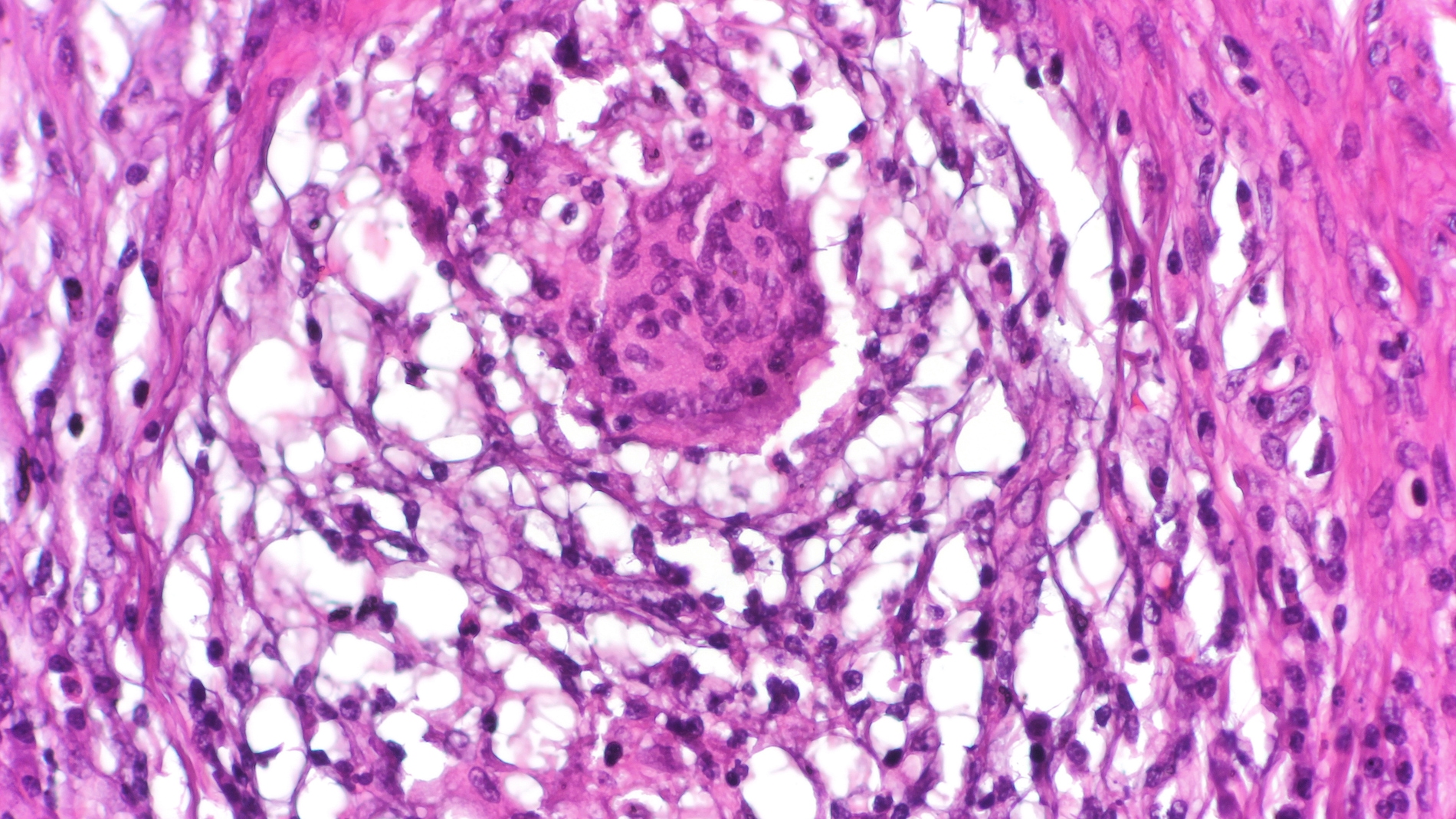 Un farmaco para tratar las fistulas de Crohn con celulas madre de donantes