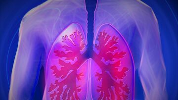 El cáncer de pulmón mata cada año a unas 23.000 personas en España