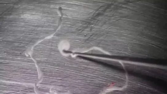 Imagen de la tenia de 12 centímetros que llevaba 15 años comiéndose el cerebro de un hombre Imagen de la tenia de 12 centímetros que llevaba 15 años comiéndose el cerebro de un hombre
