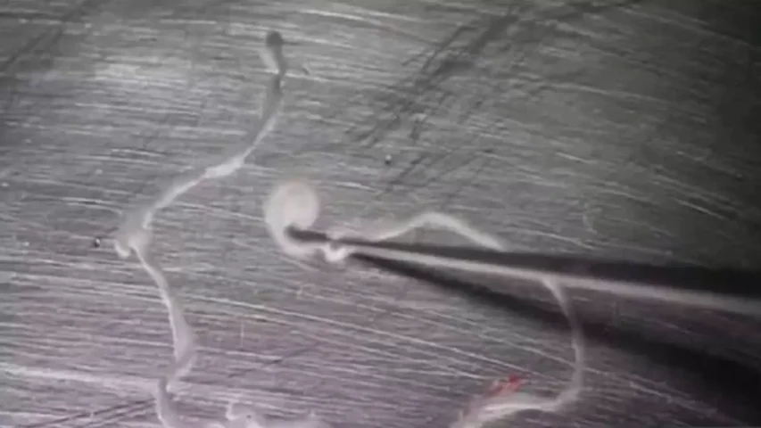 Imagen de la tenia de 12 centímetros que llevaba 15 años comiéndose el cerebro de un hombre Imagen de la tenia de 12 centímetros que llevaba 15 años comiéndose el cerebro de un hombre