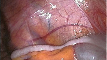 De que lado del cuerpo humano tenemos la apendice De que lado del cuerpo humano tenemos la apendice