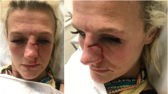 Cindy Dandois, tras sufrir una agresión por parte de su exnovio Cindy Dandois, tras sufrir una agresión por parte de su exnovio