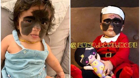 El antes y el después de Luna Fenner tras someterse al tratamiento El antes y el después de Luna Fenner tras someterse al tratamiento