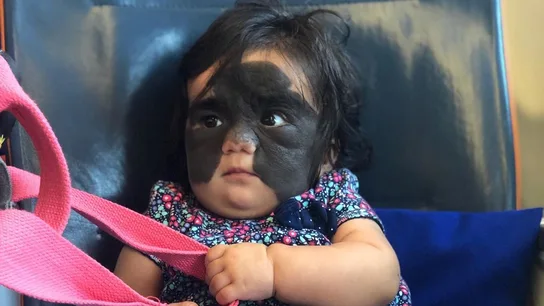 La pequeña Luna Fenner, cuando aún no había sido operada La pequeña Luna Fenner, cuando aún no había sido operada