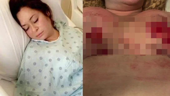 La intervención quirúrgica provocó a la mujer necrosis La intervención quirúrgica provocó a la mujer necrosis