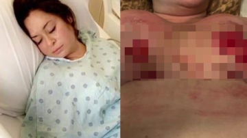 La intervención quirúrgica provocó a la mujer necrosis
