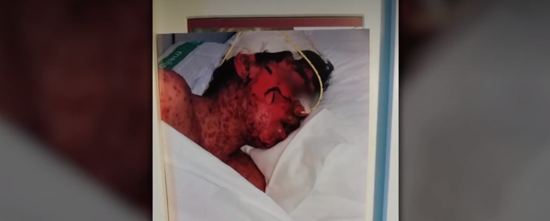 Lucas, abrasado tras una negligencia médica en Cáceres