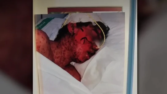 Lucas, abrasado tras una negligencia médica en Cáceres Lucas, abrasado tras una negligencia médica en Cáceres