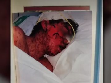 Lucas, abrasado tras una negligencia médica en Cáceres Lucas, abrasado tras una negligencia médica en Cáceres