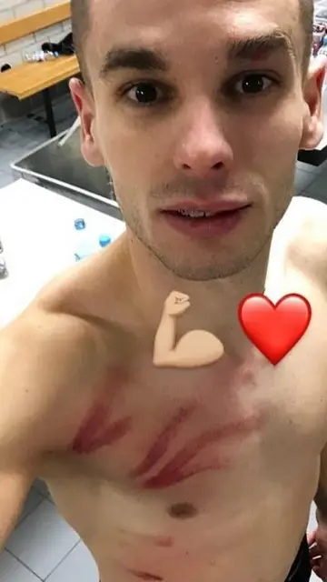 Mijat Gacinovic muestra las secuelas en su instagram Mijat Gacinovic muestra las secuelas en su instagram