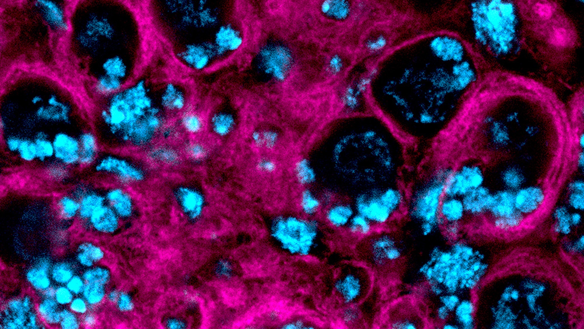 Describen un mecanismo celular clave en la progresion del glioblastoma