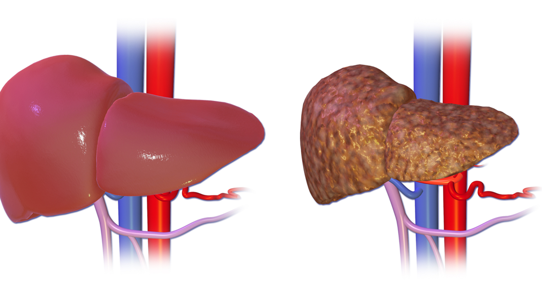 El hígado normal comparado con un hígado con cirrosis