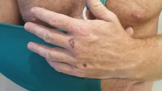 Una de las víctimas de la agresión homófoba en Torremolinos Una de las víctimas de la agresión homófoba en Torremolinos